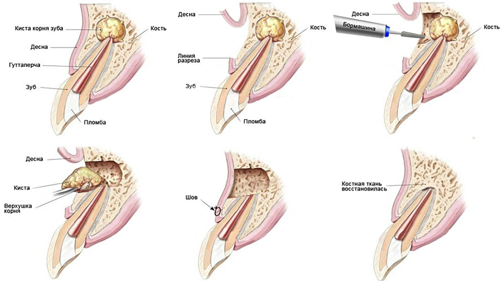 Резекция верхушки корня - удаление кисты зуба.