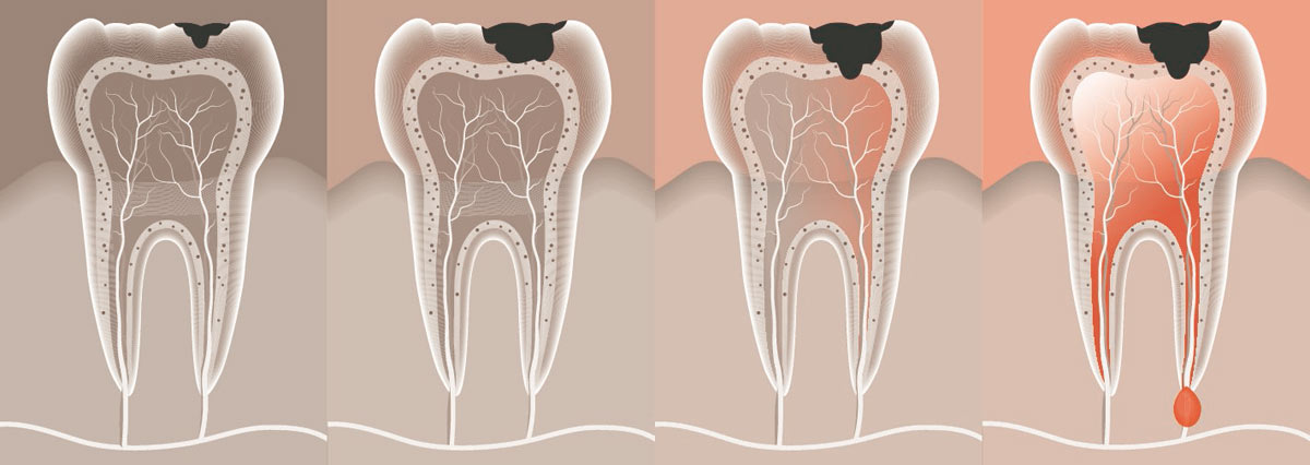 Этапы развития кисты зуба при кариесе.