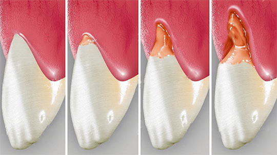 Развитие клиновидного дефекта зуба.
