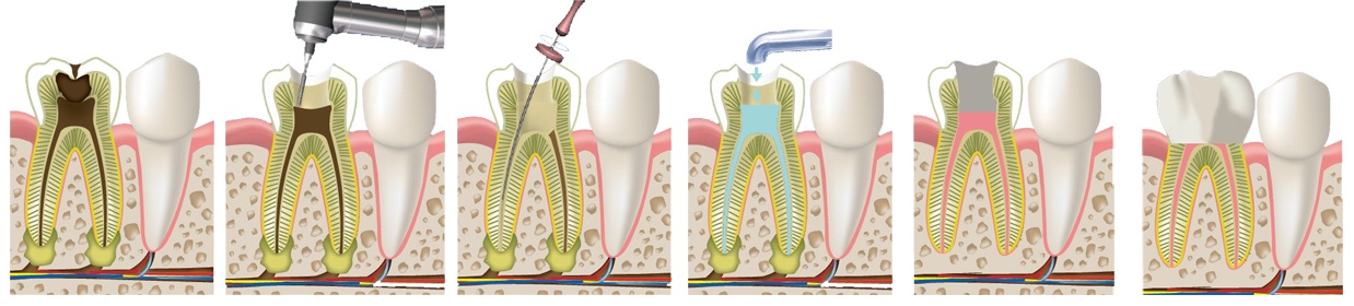 Этапы лечения пульпита
