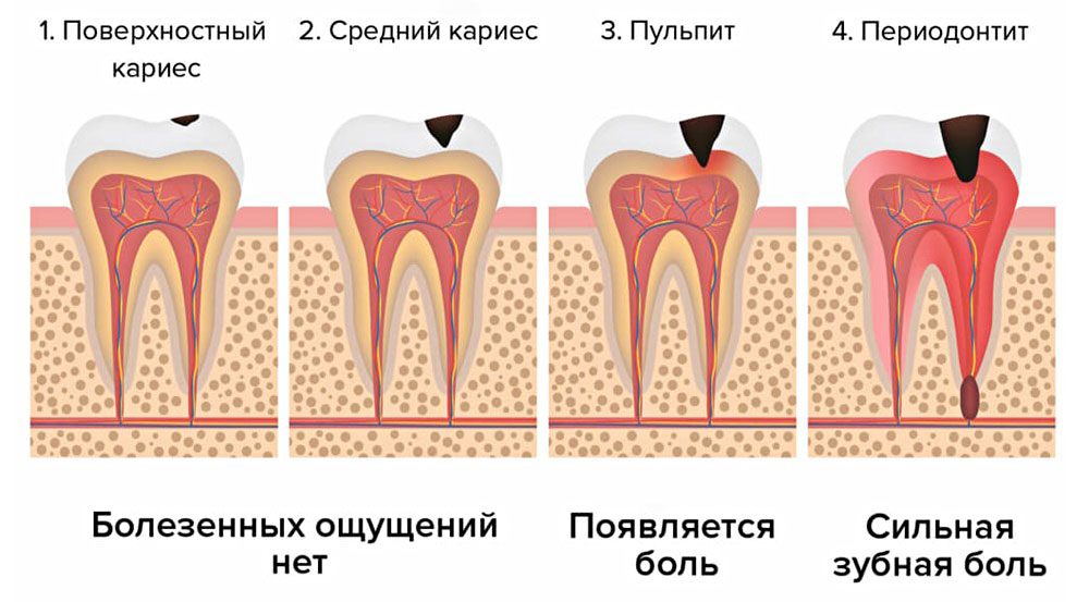 Процесс развития периодонтита на базе кариеса.