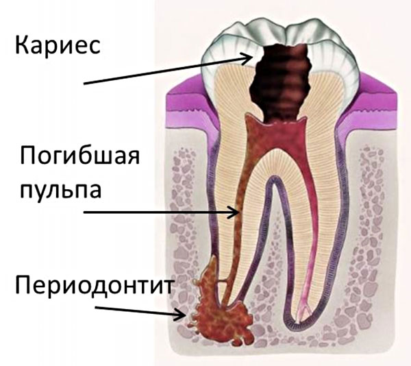 Образование периодонтита зуба.