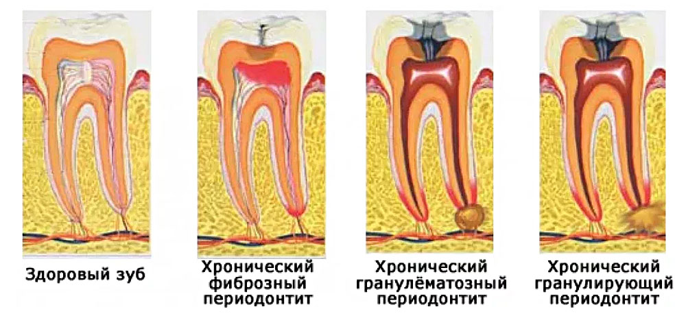 Разновидности периодонтита в зависимости от стадии заболевания.