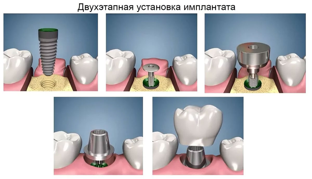 Этапы и схема классической двухэтапной имплантации.