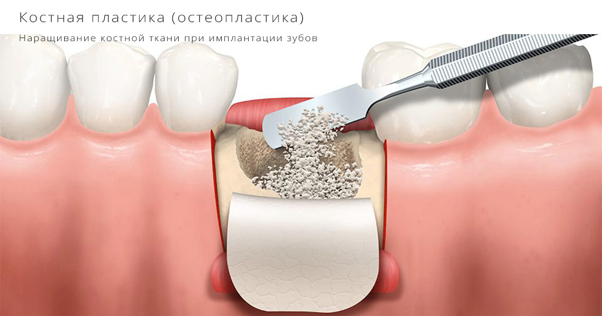 Наращивание костной ткани при имплантации зубов в Уфе.