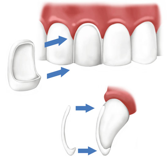 Схема установки винира на передний зуб.