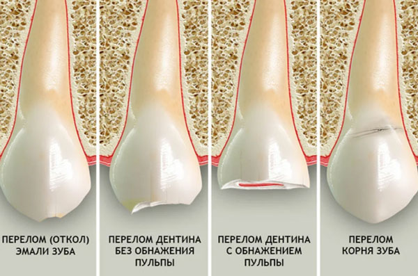 Классификация и виды переломов зуба.
