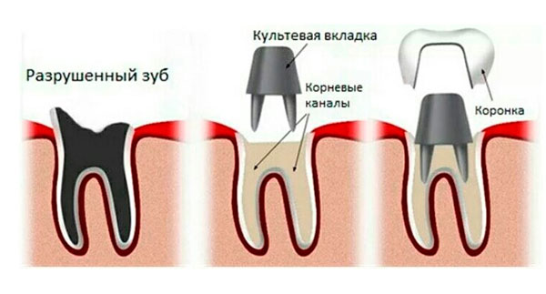 Восстановление целостности зуба коронкой.